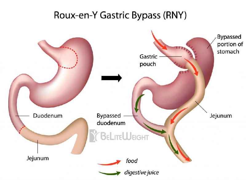 Does weight fluctuate after gastric bypass