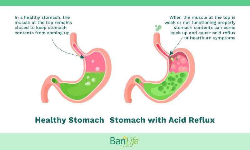 Does your stomach grow back after gastric sleeve