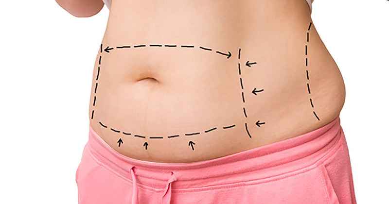 Does your stomach look bigger after breast reduction