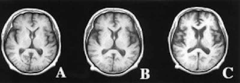 How aggressive is Lewy body dementia