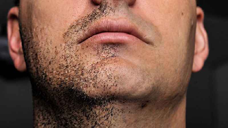 How can a woman get rid of facial hair