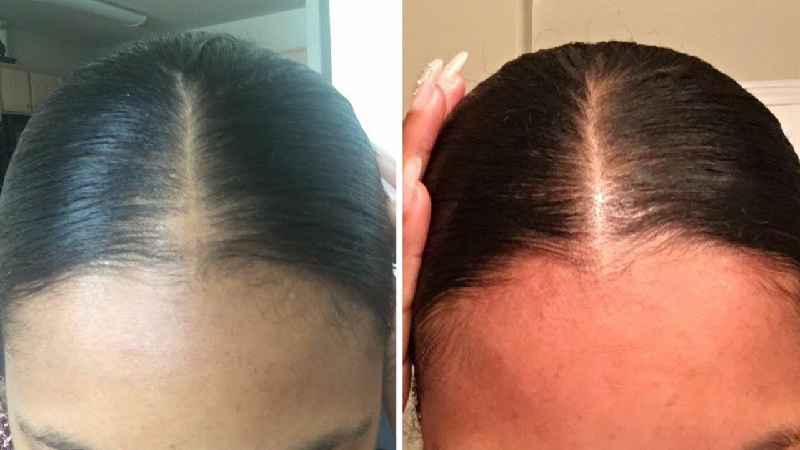 How can a woman stop hair loss fast