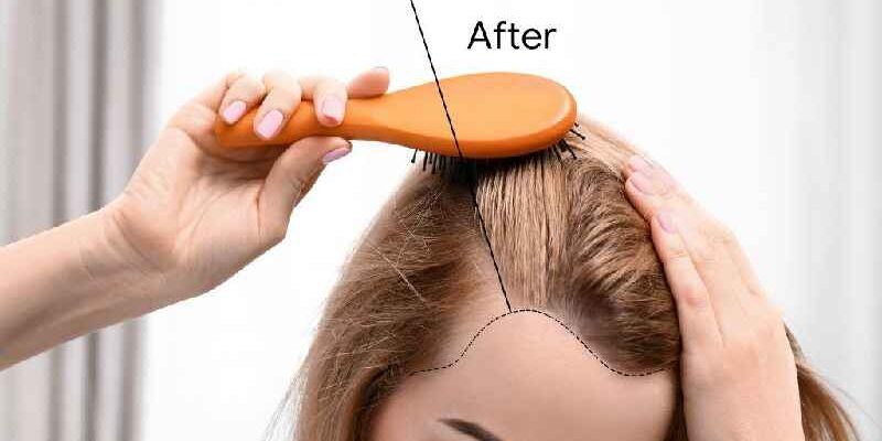How can a woman treat hair loss at home