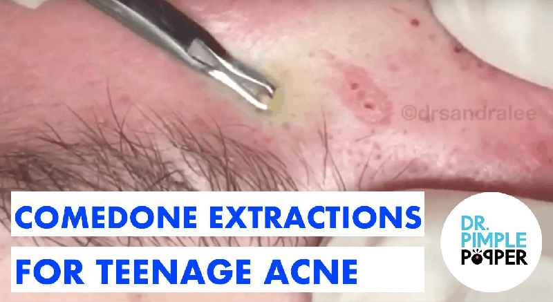 How can I clear up acne fast