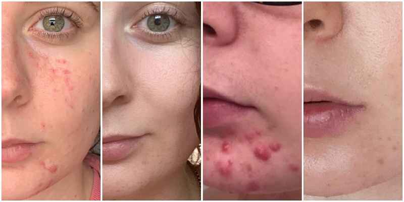How can I clear up acne fast