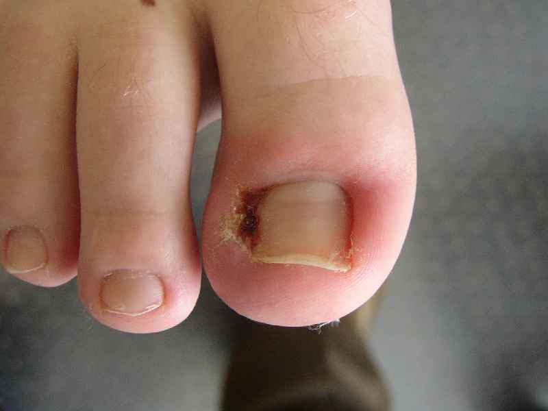 How can I fix an ingrown toenail at home