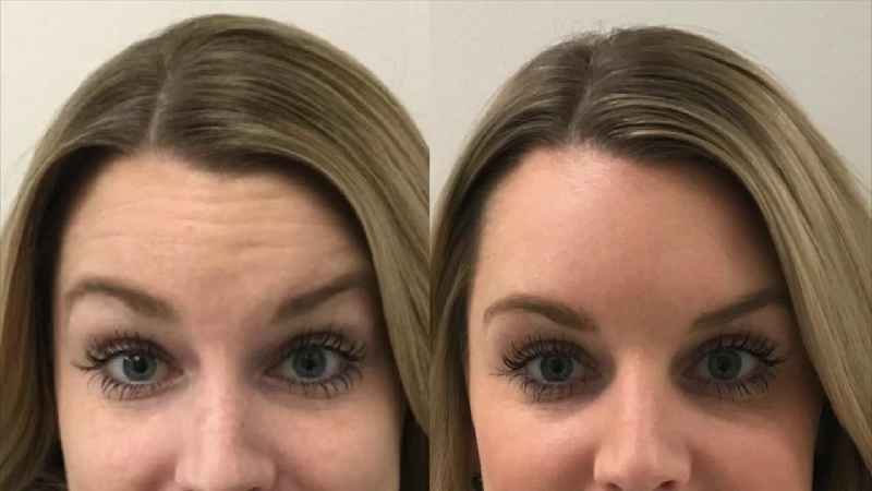How can I get rid of deep forehead wrinkles without Botox