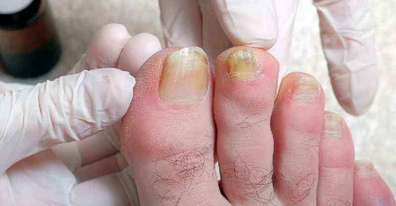 How can I heal the skin around my nails