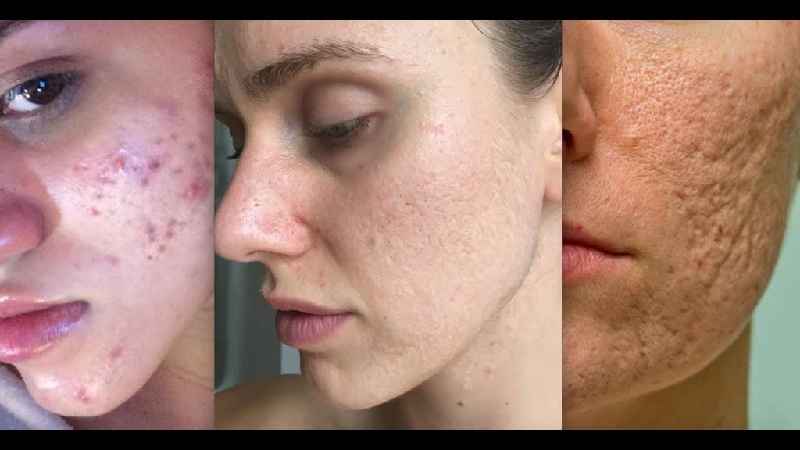 How can I improve the texture of acne scars
