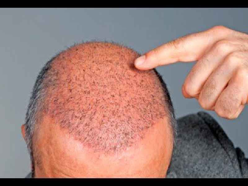 How can I make my bald spot grow back faster