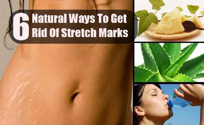 How can I permanently get rid of stretch marks naturally