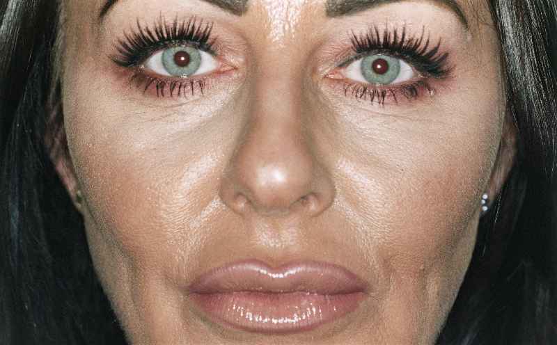 How can I plump my lips without Botox