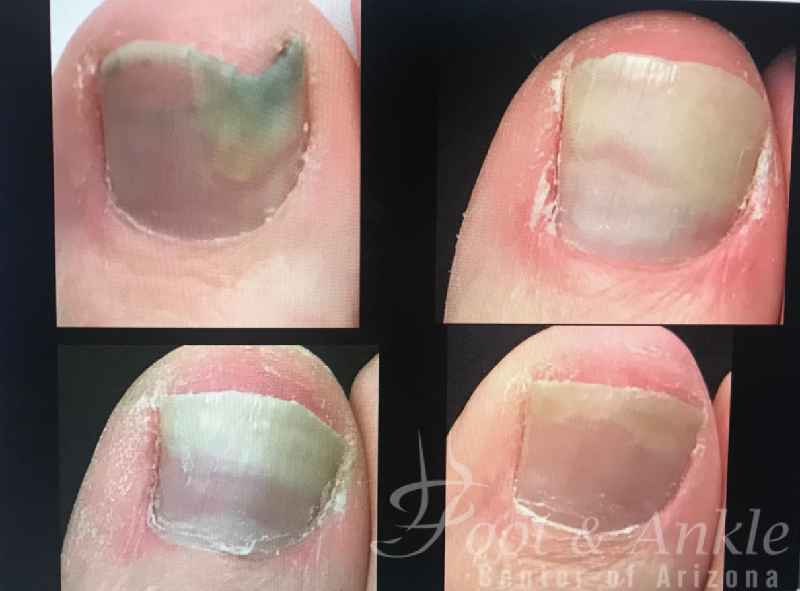 How can I protect my big toe without nail