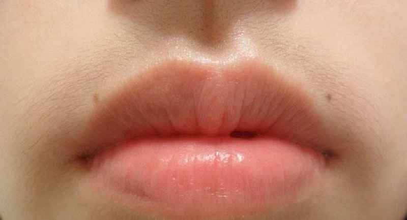 How can I reduce my upper lip hair naturally