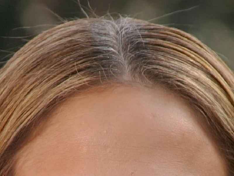 How can I regain my lost hair