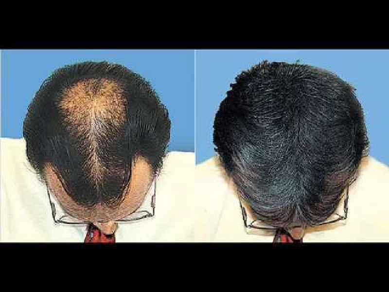 How can I regrow lost hair