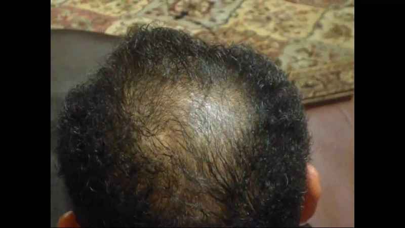 How can I regrow my bald spot