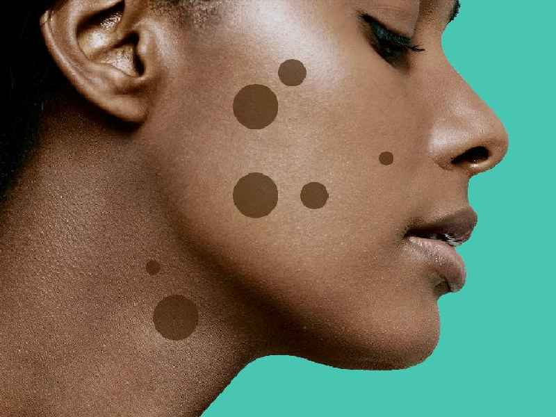 How can I remove dark spots at home permanently