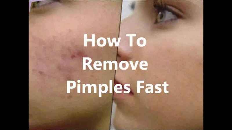 How can I remove pimple marks