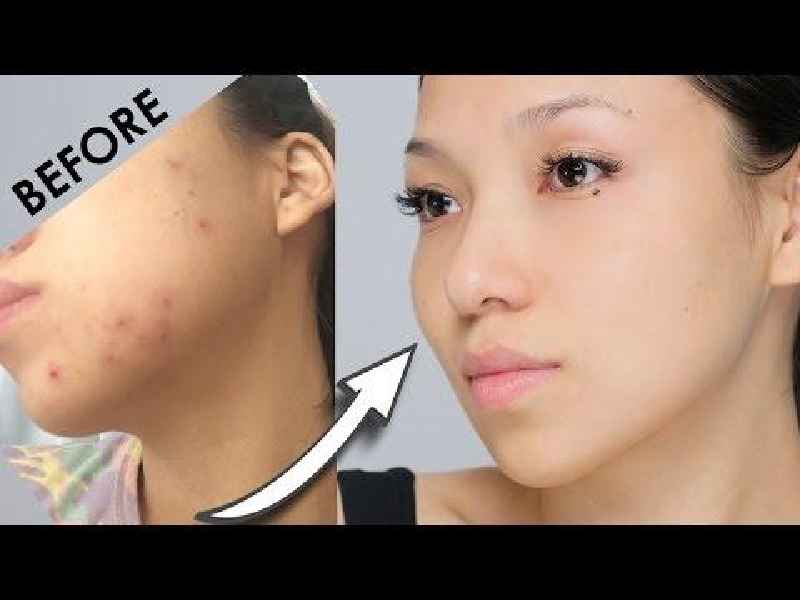 How can I remove pimple marks