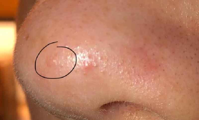 How can I remove pimples