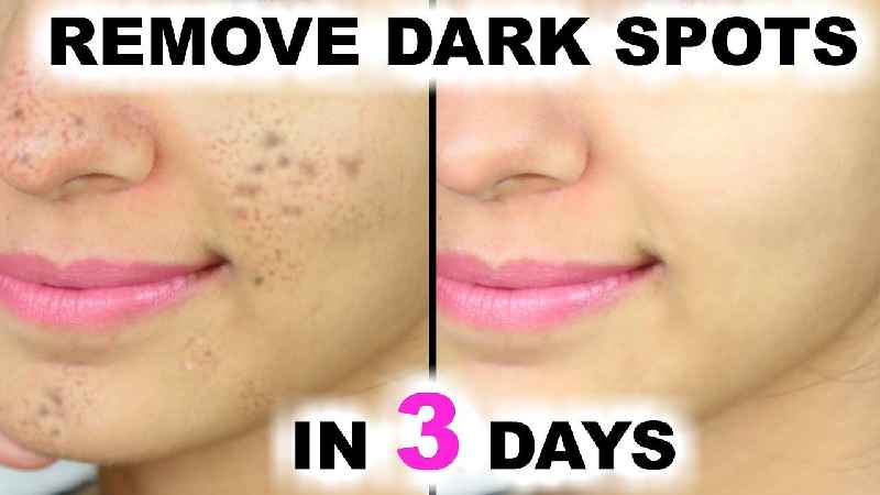 How can I remove pimples and dark spots