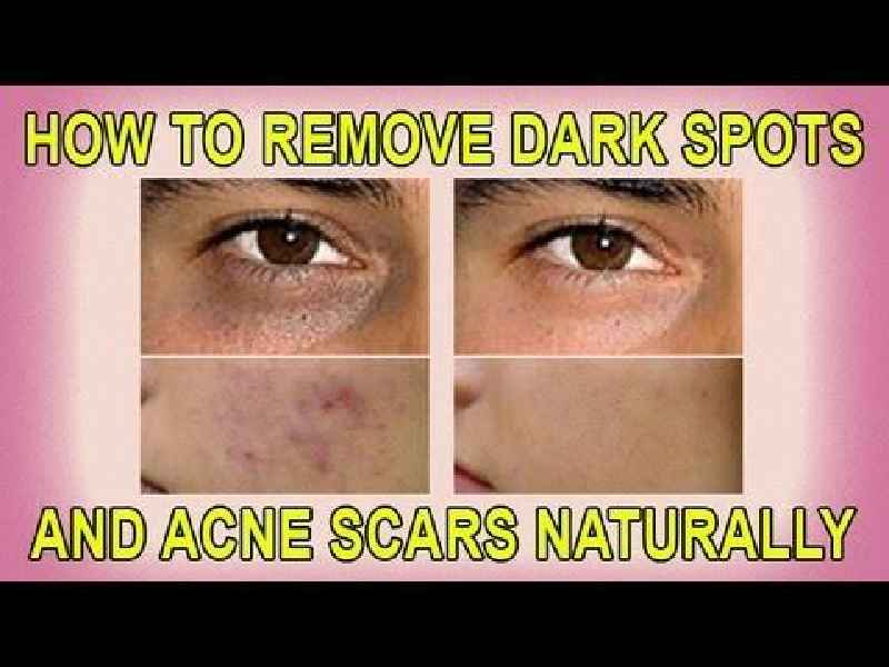How can I remove scars naturally from my face