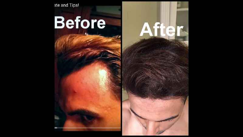 How can I reverse my hair loss naturally