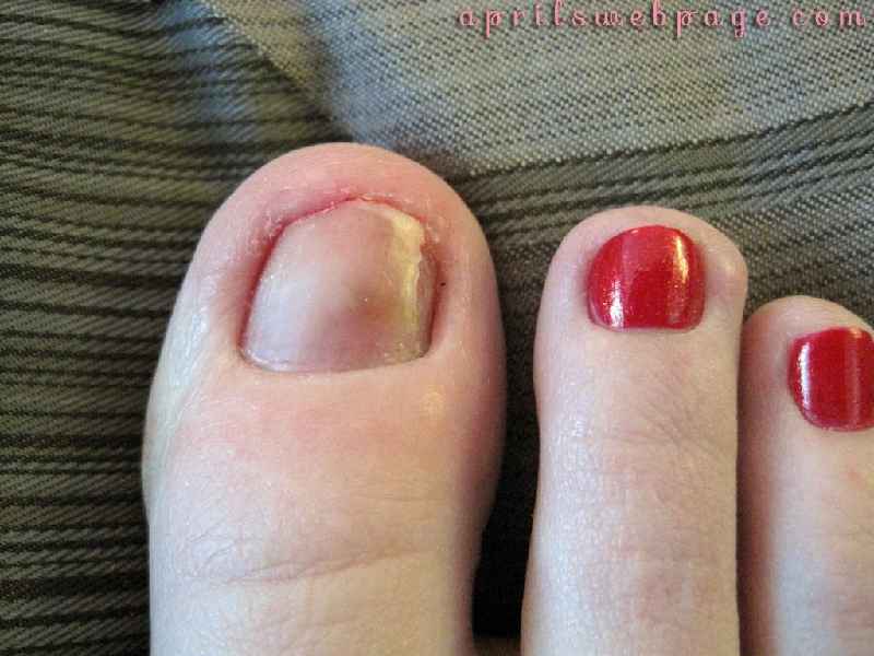 How can I stimulate my toenail growth