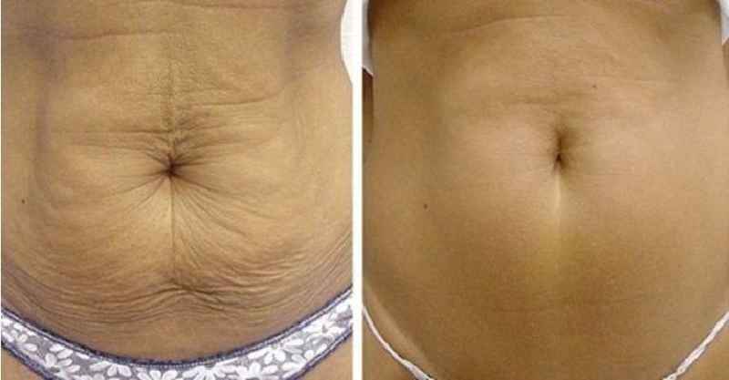How can I tighten my stomach skin naturally