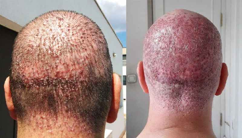 How can I treat an infected hair follicle at home