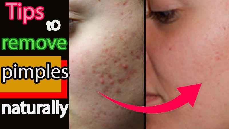 How can we reduce pimples naturally