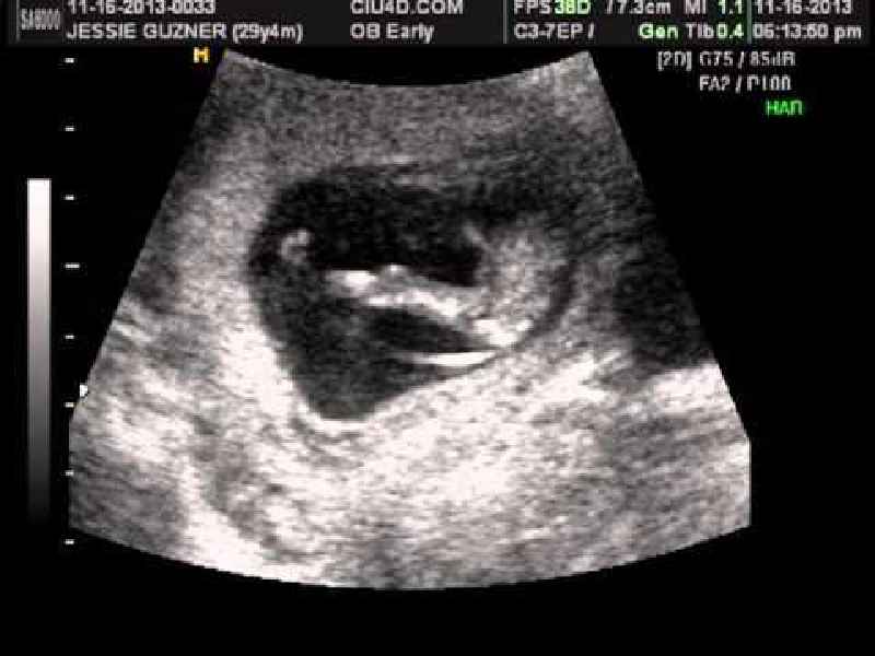 How can you tell if baby is head down without ultrasound