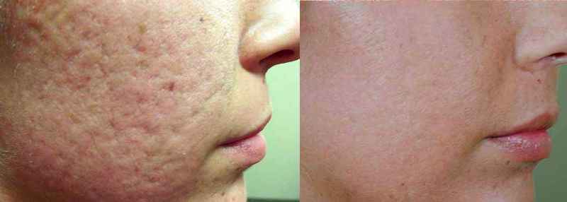 How can you tell if laser hair removal is working