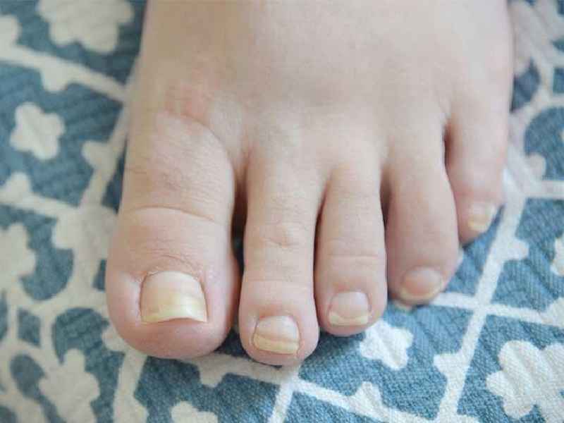 How can you tell if your nail bed is damaged