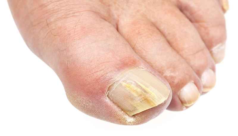 How can you tell if your toenail fungus is getting better