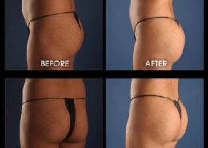 How common are buttock implants