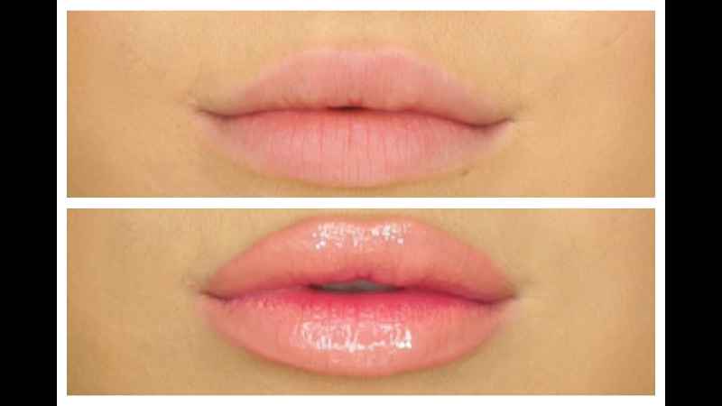 How do dermatologists make your lips bigger