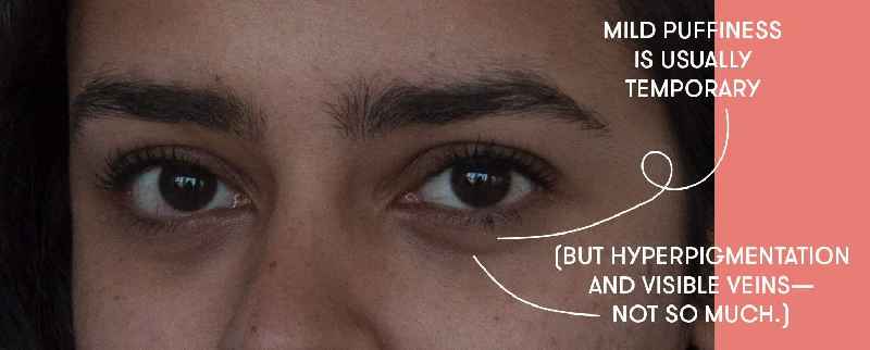 How do dermatologists remove dark circles permanently