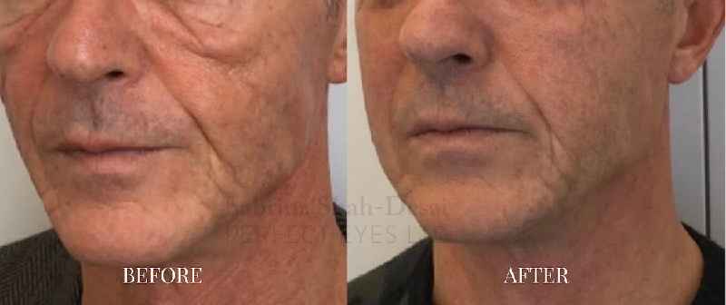 How do dermatologists tighten neck skin