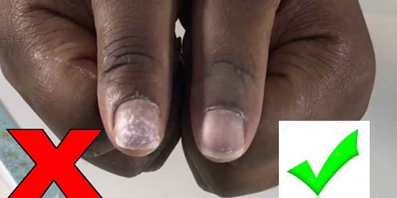 How do diabetics take care of nails