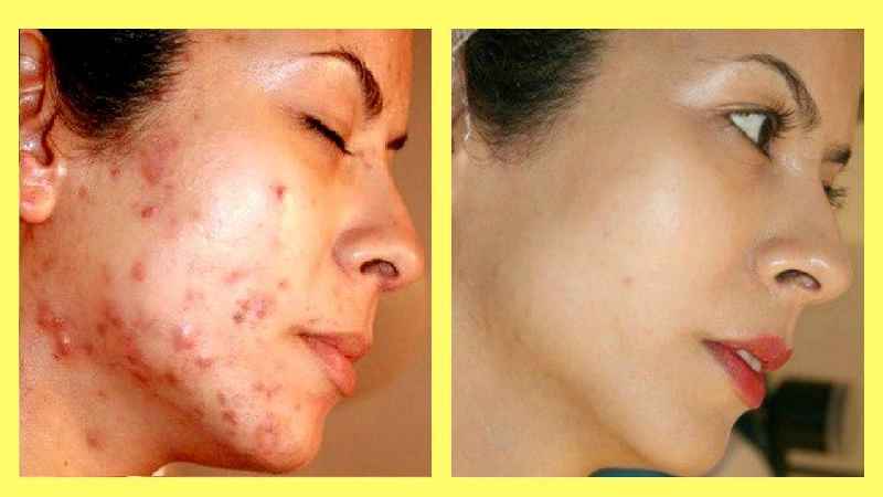 How do I get rid of dark spots and acne scars