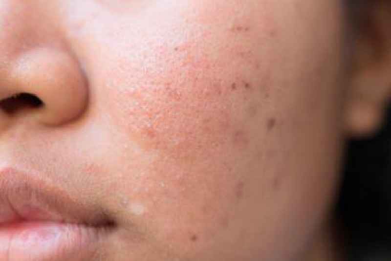 How do I get rid of deep acne scars on my face