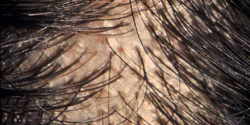 How do I know if my hair loss is normal
