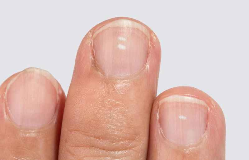 How do I know if my nail bed is damaged