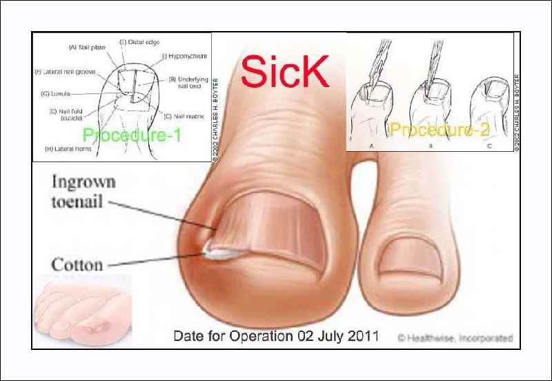 How do I know if my toe is infected after toenail removal
