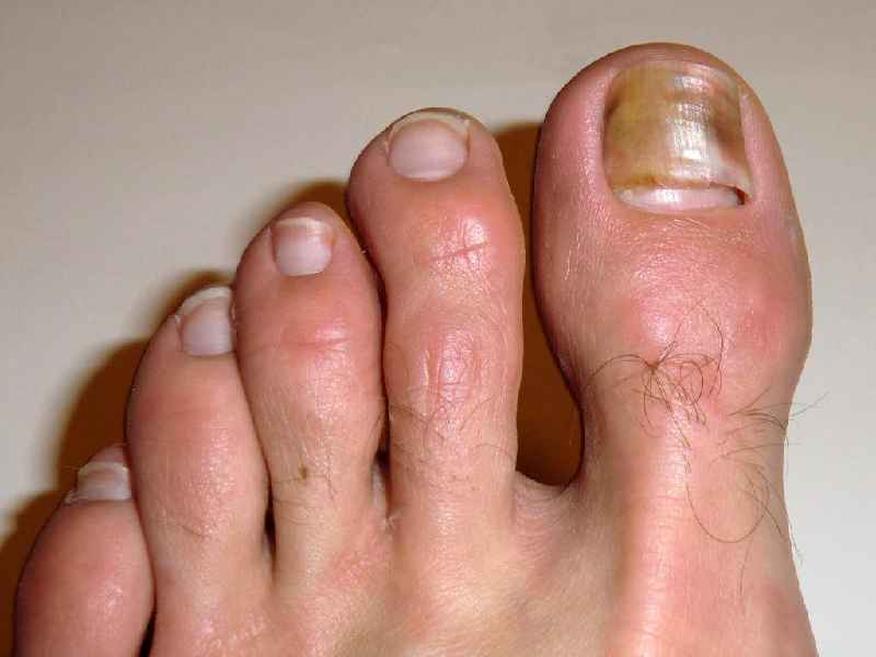 How do I know if my toenail fungus is dying