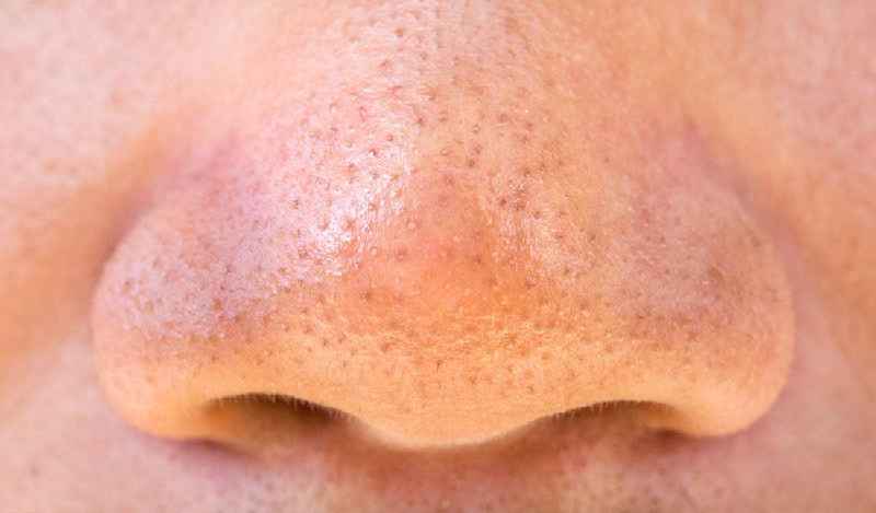 How do I prevent pimples on my face