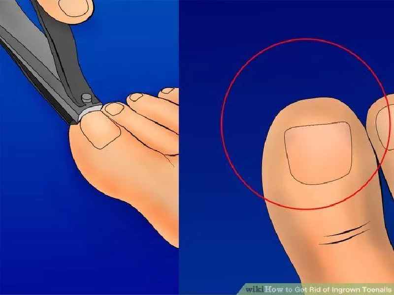 How do I put floss on my ingrown toenail
