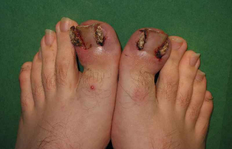 How do I stop my ingrown toenail from coming back